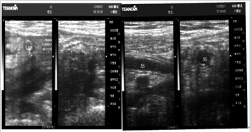 非单纯性急性阑尾炎的超声诊断价值