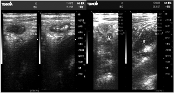 非单纯性急性阑尾炎的超声诊断价值