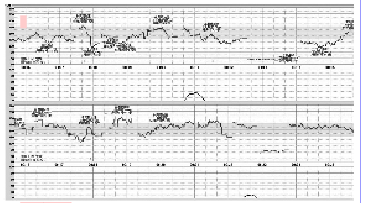 胎儿重度心动过缓分娩正常新生儿1例报告