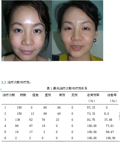 Q开关Nd:YAG激光治疗褐青色痣150例的疗效分