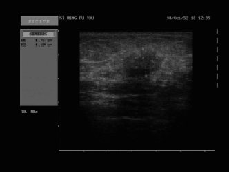 乳透、超声等在乳腺疾病影像诊断的研究进展