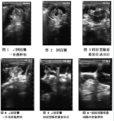 彩超监视下水压灌肠治疗小儿肠套叠207例