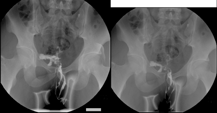 道不规则性窦道影