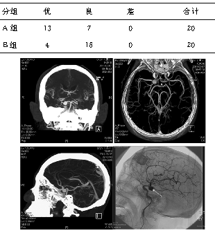 mr血管成像主要利用的是什么原理_小孔成像的原理是什么