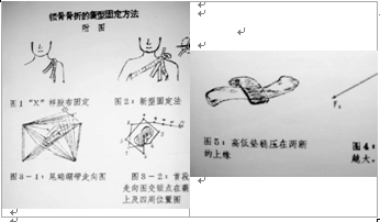 锁骨骨折的新型固定方法