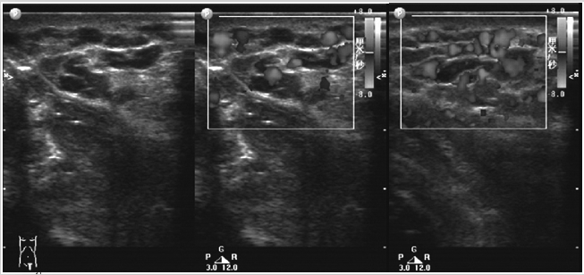 彩色多普勒超声在体表海绵状血管瘤中的诊断价