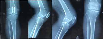 工伤髌骨骨折内固定已取出,鉴定时上面写上面功能正常