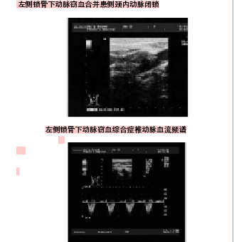 彩色多普勒超声在诊断锁骨下动脉窃血综合征的价值