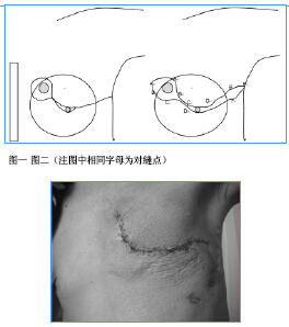 把Ⅱ期,Ⅲ期内侧乳腺癌手术病人100例,自愿原则分为:a组采用横