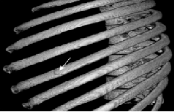 64排螺旋CT三维容积重建在肋骨骨折中的应用
