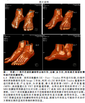 正常成人足部肌腱韧带的双能量CT与MRI成像互