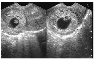 宫角妊娠的超声诊断与鉴别分析--中国期刊网