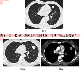 图7a:病灶肺门侧可见"尾征".图7b:增强肿瘤内见线状血管强化影.