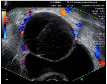 经阴道超声介入双重灌注治疗巧克力囊肿