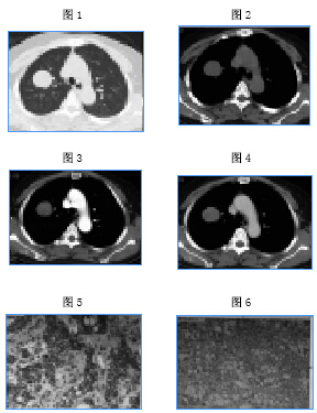 原发性周围型肺腺样囊性癌CT表现1例