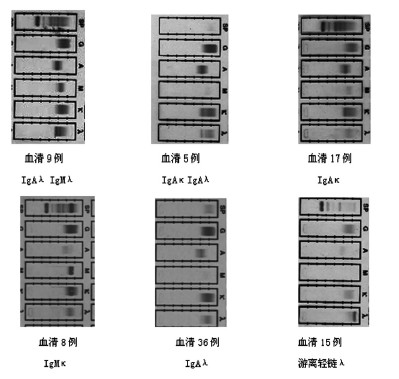 免疫固定电泳在96 例骨髓瘤肾脏病患者诊断中的意义