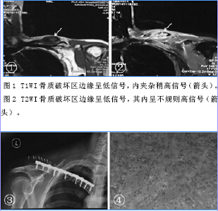 成人锁骨朗格汉斯细胞组织细胞增生症1例