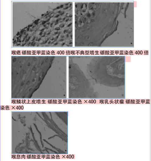 HP在喉癌及癌前病变中感染的相关研究