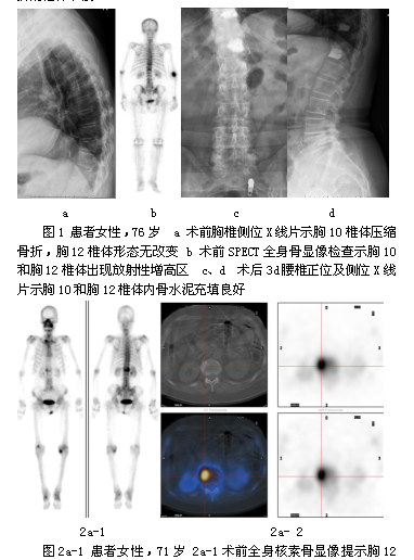 核素骨显像对老年新鲜骨质疏松性椎体压缩骨折