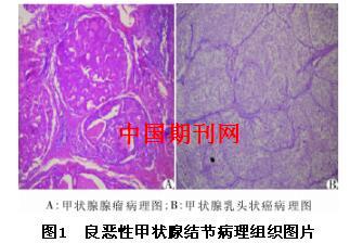 弹性成像对甲状腺结节诊断中的应用及进展