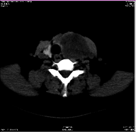 甲状腺结节性病变CT诊断及鉴别诊断