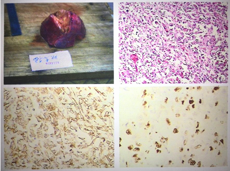 肝肉瘤样癌持续发热粒细胞增多1例