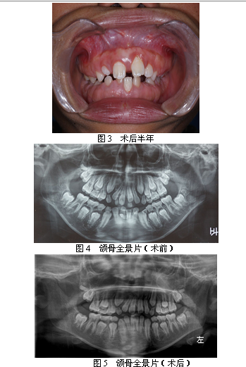 全口牙龈纤维瘤病一例及文献复习