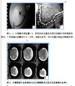 颅脑损伤术中急性脑膨出病例分析