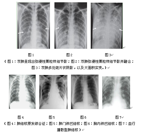 老年人肺结核的x线影像分析