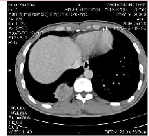 结核性胸膜炎化疗期类赫氏反应肺部影像学鉴别