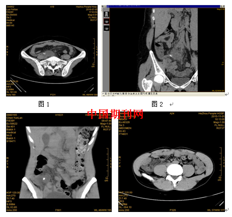多层螺旋CT在穿孔阑尾炎中的诊断价值分析