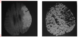 关于多模式磁共振影像技术在急性脑梗死早期诊断中的价值的毕业论文题目范文