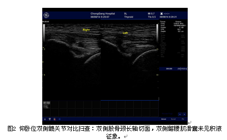 高频超声观察退行性髋关节病