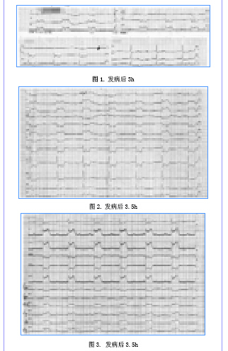 急性st段抬高型心肌梗死并发心源性休克,完全房室传导