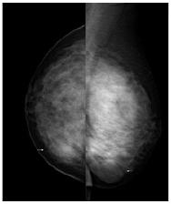 关于32例乳腺叶状肿瘤临床的毕业论文开题报告范文