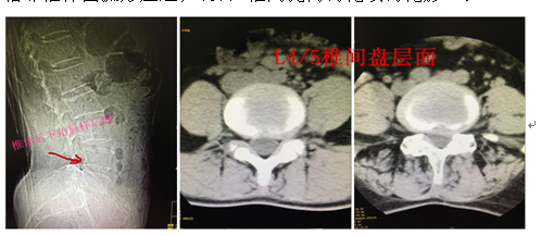 X线平片与CT诊断腰椎间盘突出的对照分析