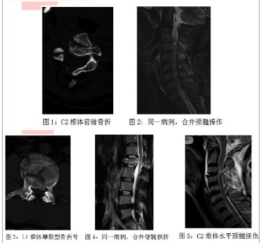 CT和MRI在脊柱损伤诊断中的联合应用
