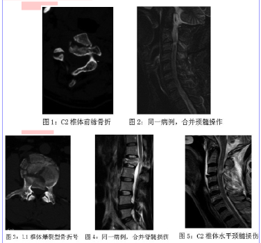 分析CT与MRI对脊柱外伤的诊断价值