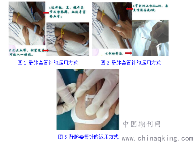 不同方法静脉注射在婴幼儿ct增强扫描中的应用价值比较