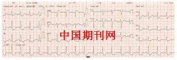 体表心电图诊断左主干病变一例