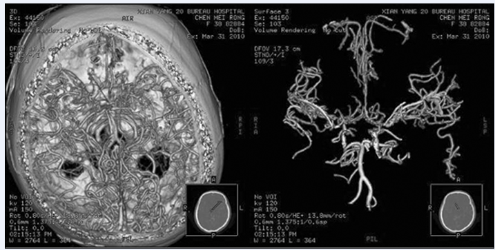 脑血管病颅脑CTA与DSA的比较