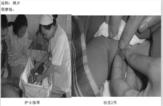 新生儿期开始手法干预预防婴幼儿包茎形成的临床观察