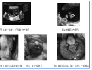 超声产前诊断无叶全前脑1例并文献复习