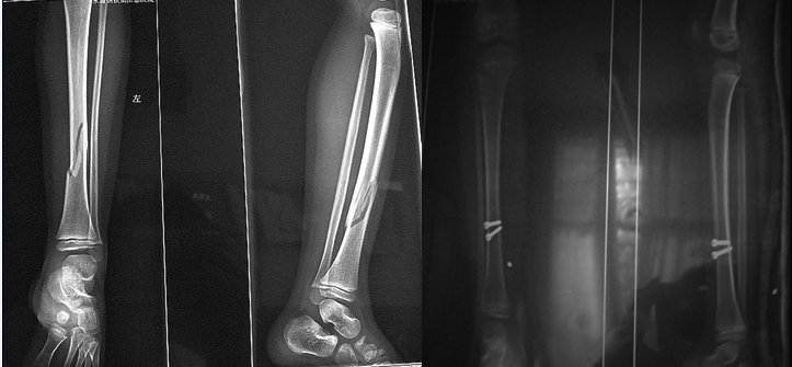 有限切开内固定结合外固定治疗儿童胫骨骨折