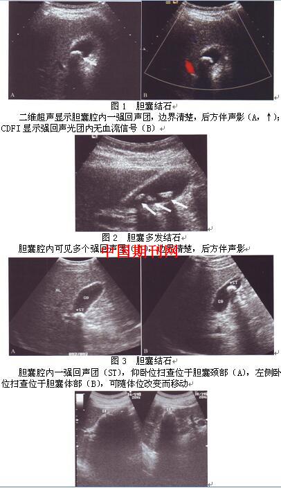 胆囊结石的超声表现及诊断