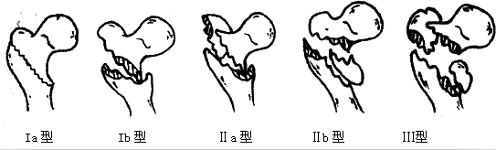 Ⅱb型:有小粗隆分离骨折的三部分骨折,因小粗隆或股骨矩骨折缺乏内侧