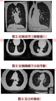多层螺旋CT肺部低剂量扫描的体检应用