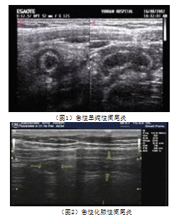 急性阑尾炎彩色多普勒超声影像图像特征及诊断