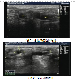急性阑尾炎彩色多普勒超声影像图像特征及诊断