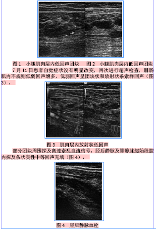 肌间静脉血栓并深静脉血栓1例
